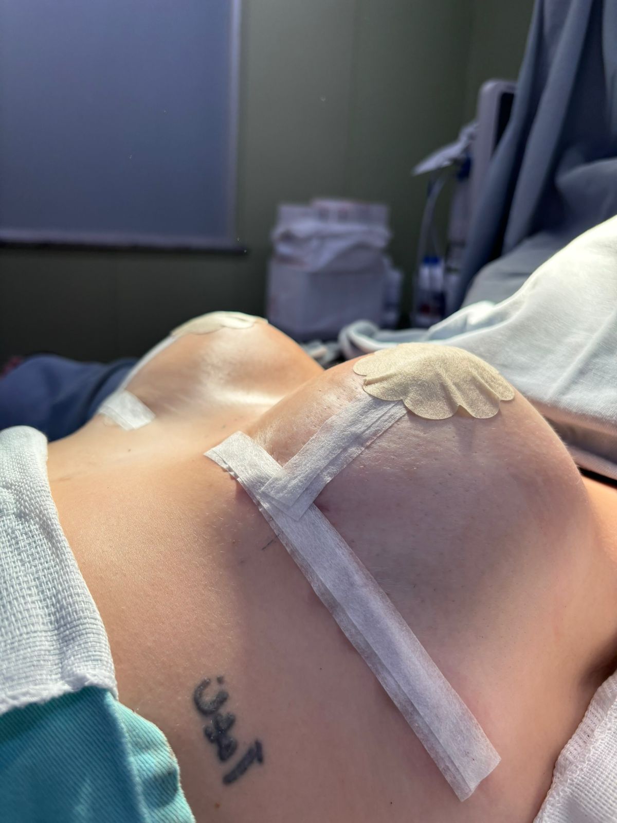 Resultado após cirurgia - Caso 5